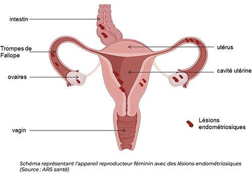 Sch&eacute;ma m&eacute;dical de l&rsquo;appareil reproducteur f&eacute;minin montrant des l&eacute;sions d&rsquo;endom&eacute;triose sur l&rsquo;ut&eacute;rus, les ovaires, les trompes de Fallope et l&rsquo;intestin